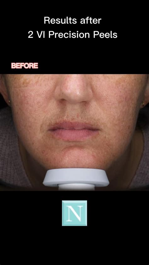 Good Vibrations Unclog Nose Pores Shorts Artofit