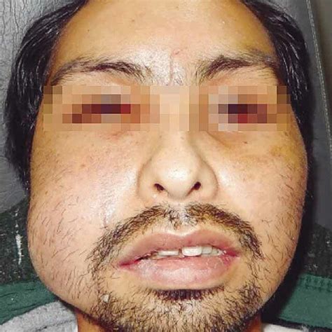 Paciente Con Aumento De Volumen Regi N Preauricular Derecha Download