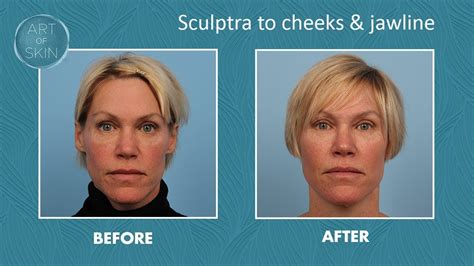 Sculptra Filler For Cheeks And Jawline Youtube