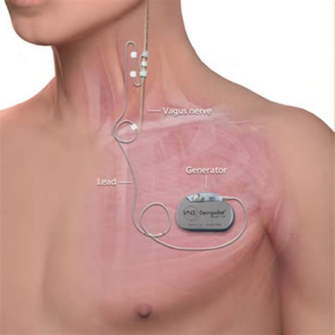 Vagus Nerve Stimulator Implant